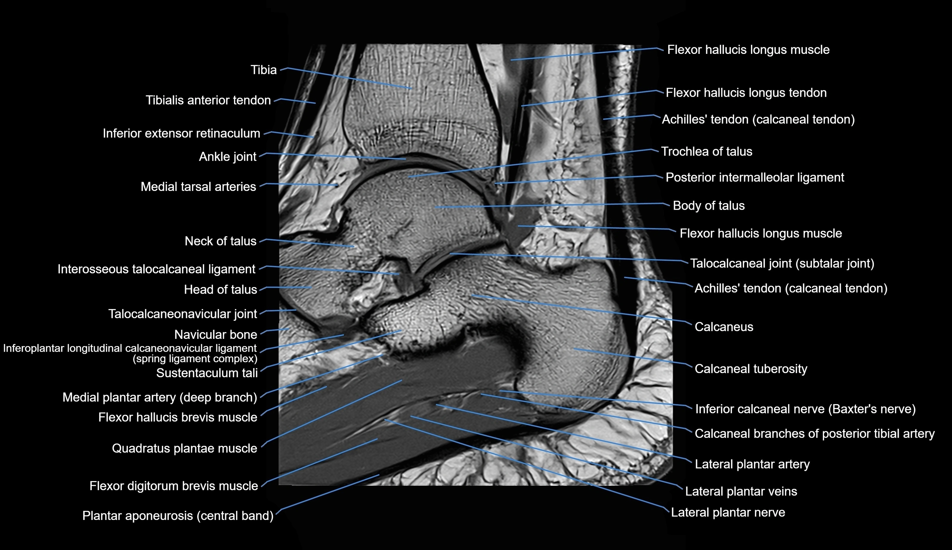 MRI Ankle sagittal cross sectional anatomy 3T  radiology  image-img-00001-00016.webp